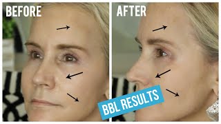 BBL LIGHT TREATMENT BEFORE AND AFTER  MY BBL LASER TREATMENT FOR BROWN SPOTS amp SPIDER VEINS [upl. by Crockett]