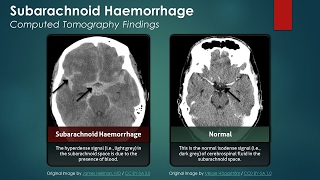 What is a Subarachnoid Hemorrhage [upl. by Eibrad]