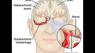 Subarachnoid Hemorrhage [upl. by Adiazteb]