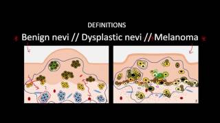 Introduction to Skin Cancer 3 Overview of Nevi and Melanoma [upl. by Siri]