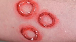 DISGUSTING RINGWORM [upl. by Narat]