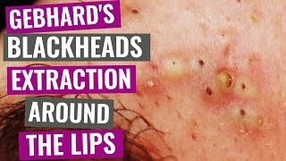 Gebhards Blackheads extraction around the lips [upl. by Hendrik]