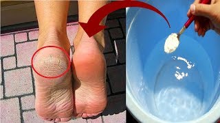 In Just 3 Minutes  Get Rid of CRACKED HEELS Permanently Magical Cracked Heels Home Remedy [upl. by Maxa441]