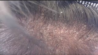 How to treat Flaky skin and Flaky scalp [upl. by Stewart7]