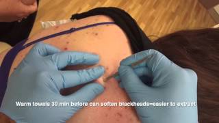 Blackheads back removal  the Australian Anaconda [upl. by Colwin44]