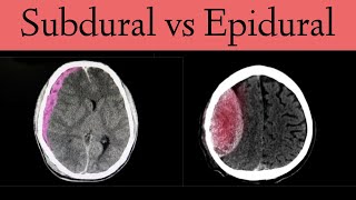 Recognizing subarachnoid hemorrhage on computed tomography CT [upl. by Radborne]