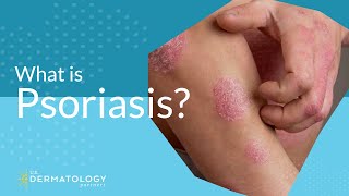 What Is Psoriasis [upl. by Agnot947]