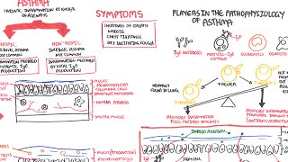 Asthma  signs and symptoms pathophysiology [upl. by Akcired]