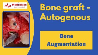 Avance Nerve Graft® Handling [upl. by Regen]