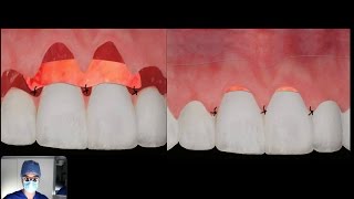 How does a CONNECTIVE TISSUE graft work [upl. by Ees518]