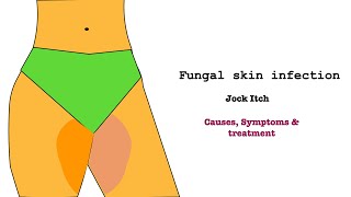 Jock itchFungal Infection on skinTineaRingwormFungal infection on nailtreatment and prevention [upl. by Nazar]