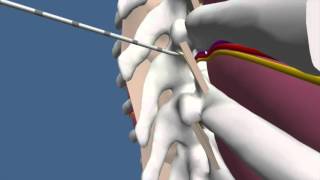 Techniques for Thoracic Paravertebral Block TPVB [upl. by Anha]