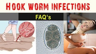 Hook worm Infections  FAQ and Answers [upl. by Sankey]