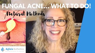 HOW TO CLEAR FUNGAL ACNE NATURALLY  NO MEDICATION OR NIZORAL [upl. by Tally]