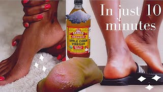 how to remove dead skin from your feet naturally at home 2021 cracked heels home remedy [upl. by Haggi960]