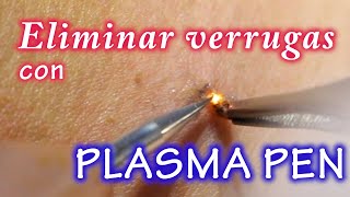 ELIMINANDO VERRUGAS CON PLASMA PEN [upl. by Lait]