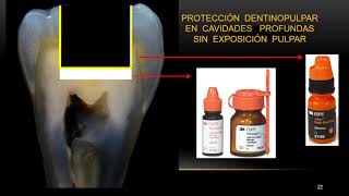 Protección dentino Pulpara Principios de la Adhesion [upl. by Elletsirhc]