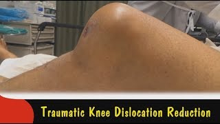 Traumatic Knee Dislocation Reduction [upl. by Renruojos]