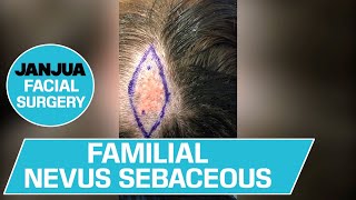 FAMILIAL NEVUS SEBACEOUS  DR TANVEER JANJUA  NEW JERSEY [upl. by Boote]