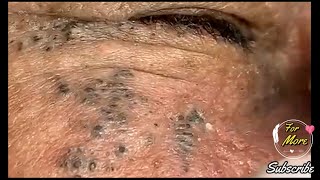 Dr Pop  Deep Blackheads in old Skin removing amp treatment 2020 Part 5 [upl. by Sparke973]