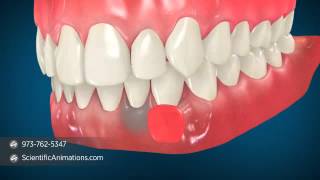 Patient Treatment Videos Gingival Graft Alloderm [upl. by Atnes]