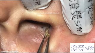 Giant Ear Acne Removal Blackheads  How To REMOVE BLACKHEADS  Part 1 [upl. by Damales]