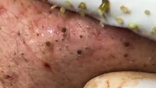 Blackheads [upl. by Tips]