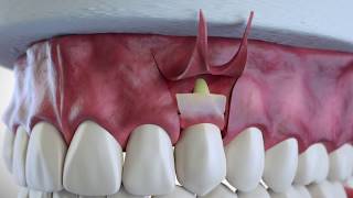 Subepithelial Connective Tissue Grafting [upl. by Norab]