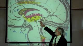 Subdural vs Epidural HematomaHemorrhage CT Scan Findings [upl. by Jollanta]