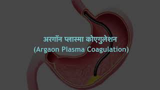 DR PRAVIN SURYAWANSHI  Argaon Plasma Coagulation [upl. by Atirb885]