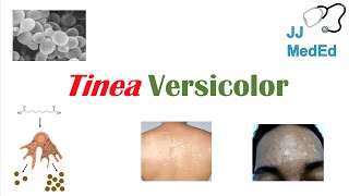 “Fungal Skin Infection of Many Colors” Tinea Versicolor  Pathogenesis Symptoms and Treatment [upl. by Ling]