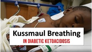 Kussmaul Breathing in Diabetic Ketoacidosis [upl. by Arabel241]