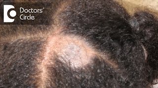 What causes Scalp Ringworm Effective Treatment   Tinea Capitis  Dr Tina Ramachander [upl. by Mano]