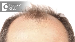 Treatment for male pattern baldness in Ayurveda  Dr Farida Khan [upl. by Aiyotal406]